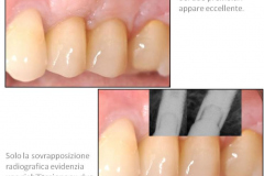 1_0001-implantologia3_dentista_centra_mestre