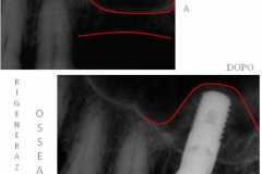 1_0002-implantologia4_dentista_centra_mestre