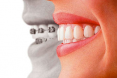 1_0001-ortotrasparente1_dentista_centra_mestre