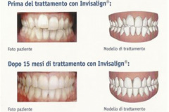 1_0003-ortotrasparente3_dentista_centra_mestre