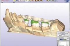 1_0001-protesi1_dentista_centra_mestre
