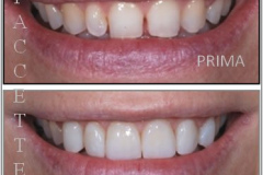 1_0004-protesi4_dentista_centra_mestre