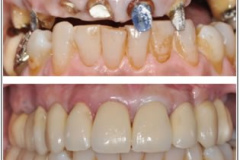 1_0005-protesi5_dentista_centra_mestre